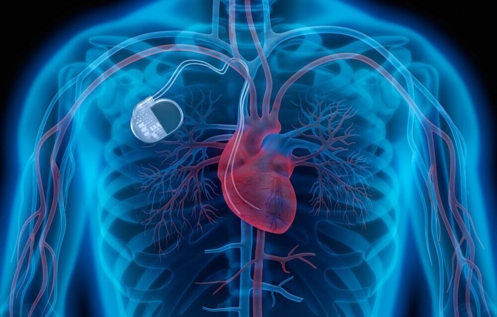 Pacemakers Americanhealth